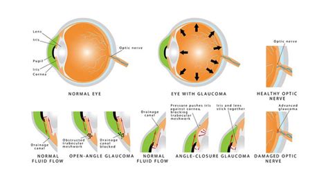 Glaucoma Treatment: All That You Need To Know About The Silent Killer Of Sight - Gud Story