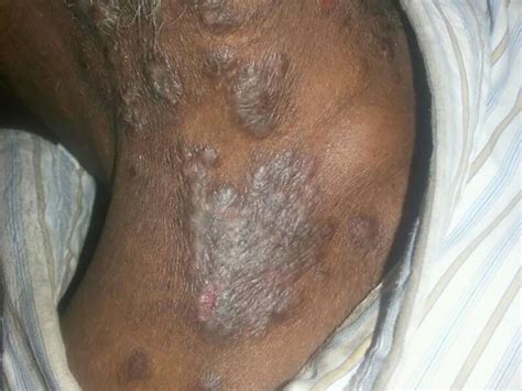 Psoriasis on black skin: Pictures, symptoms, and treatment