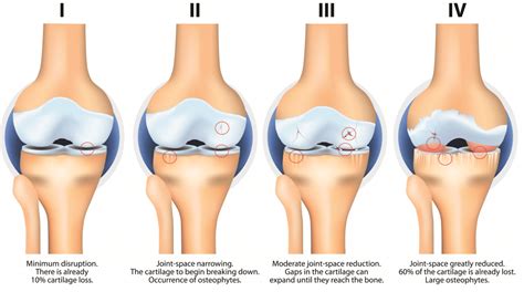 Osteoarthritis - Pathophysiology - Clinical Features - TeachMeSurgery