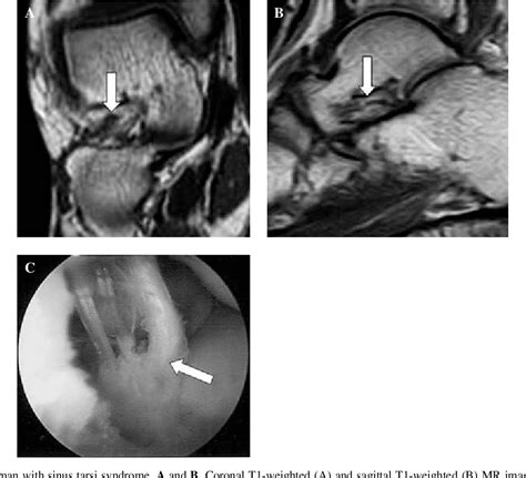 Figure 2 from Efficacy of MRI Versus Arthroscopy for Evaluation of Sinus Tarsi Syndrome ...