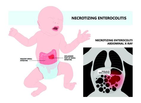 Necrotizing Enterocolitis Stage