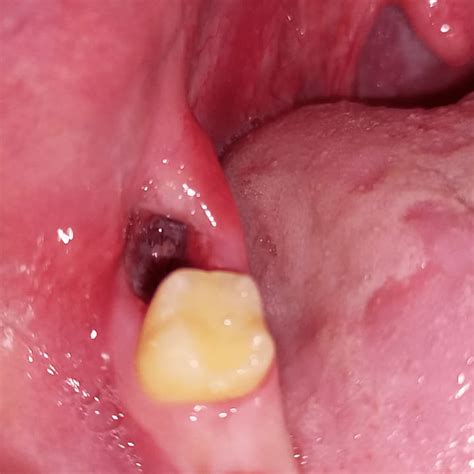 What Does Dry Socket Look Like After Wisdom Tooth Extraction