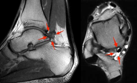 posterior ankle impingement | coachingultrasound