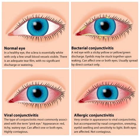 Pink Eye (Conjunctivitis) Symptoms, Treatments And Prevention | MyBelize.Net