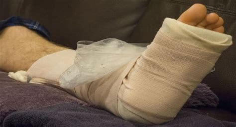 Care of fractures: 5 dos and don’ts when you have a cast or splint