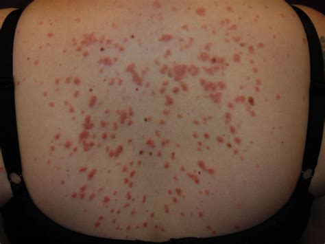 Guttate Psoriasis: Symptoms, Causes, Diagnosis, Treatment