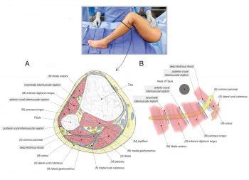 Common Peroneal Nerve Release at the Fibular Head | Surgical Education / Learn Surgery ...