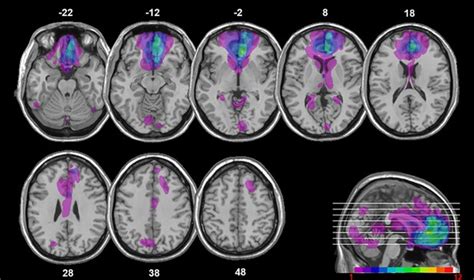 The role of ventromedial prefrontal cortex in reward valuation and future thinking during ...