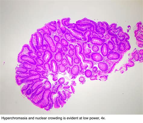 Pathology Outlines - Tubular adenoma