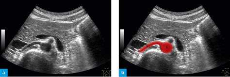 Proximal Renal Artery Ultrasound