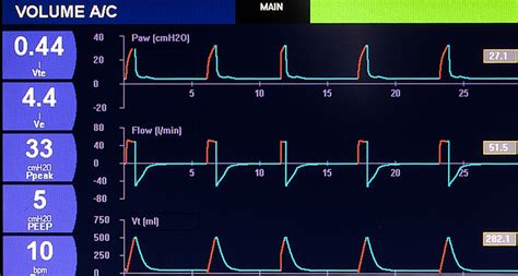 Mechanical ventilation I: Basic concepts – Critical Concepts