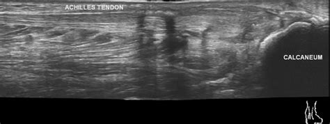 Achilles Tendon Tear Ultrasound