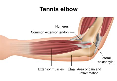 Ligaments of the Elbow - JOI Jacksonville Orthopaedic Institute