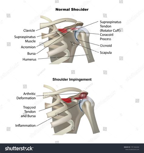 1,597 Impingement Images, Stock Photos & Vectors | Shutterstock