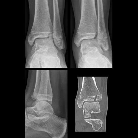 Salter-Harris Fracture | Pediatric Radiology Reference Article | Pediatric Imaging | @pedsimaging