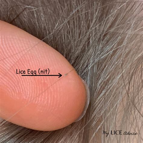 How to Check Your Child's Head for Lice: Simple Steps with Pictures