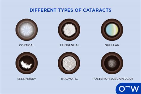 Cataracts: Definition, Types, Causes, Symptoms, Treatment, and Prevention