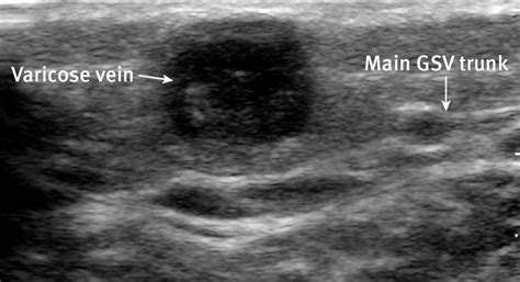 Superficial Venous Thrombosis