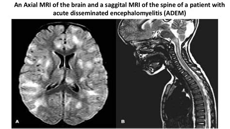 Acute disseminated encephalomyelitis