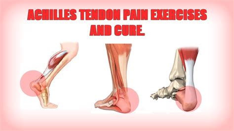 Achilles tendon pain exercises and cure. - YouTube