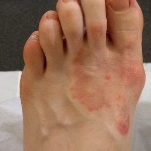 Fungal Foot Problems - Footman Podiatry