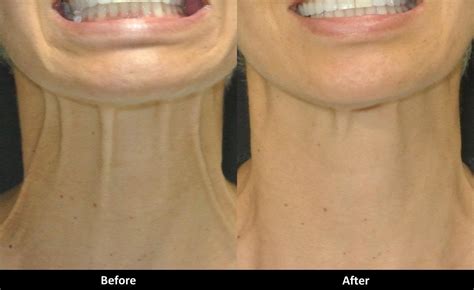 Botox can treat your vertical neck bands