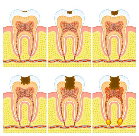 Stages of Tooth Decay | Wellness BioDentistry