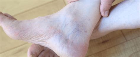 How Do Varicose Veins Develop on The Ankles?