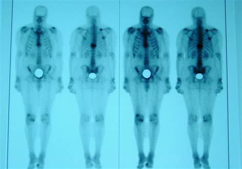 CasesBlog - Medical and Health Blog: Prostate Cancer with Bone Metastases and PSA of 900 ng/mL