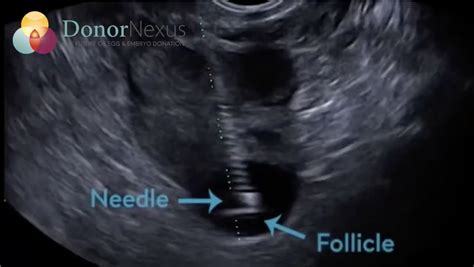 Egg Retrieval Procedure: What to Expect