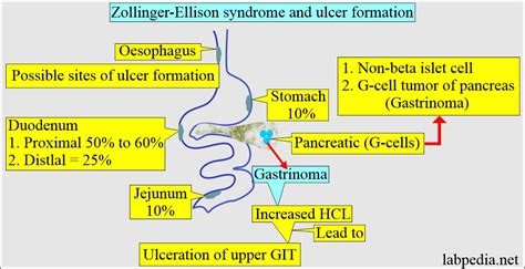 Zollinger-Ellison Syndrome, gastrinoma