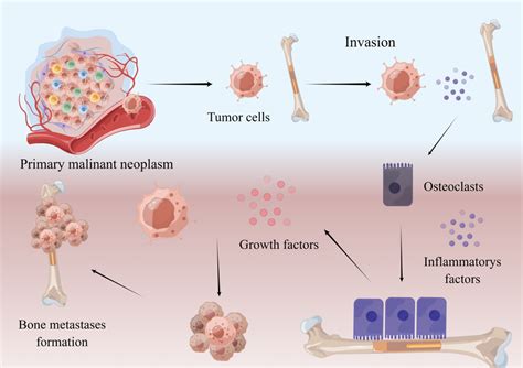 Mechanism of bone metastasis. Malignant neoplasm cells break away from ...