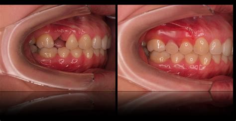 Metal-free partials and dentures - Cynthia E. Paquette DDS