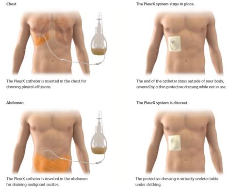 PleurX Drainage System | 500/1000 mL Kit | Vitality Medical