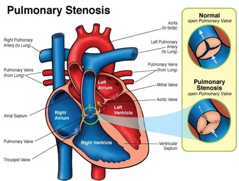 Pulmonary Stenosis and Noonan Syndrome | Noonan Syndrome Awareness ...