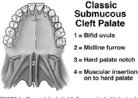 Table 1 from Classic and Occult Submucous Cleft Palates: A Histopathologic Analysis | Semantic ...