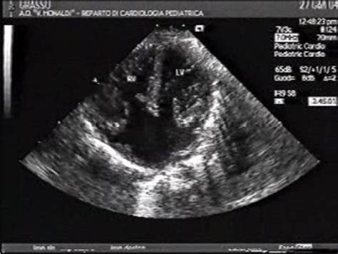 Atrioventricular septal defect echocardiography or ultrasound - wikidoc