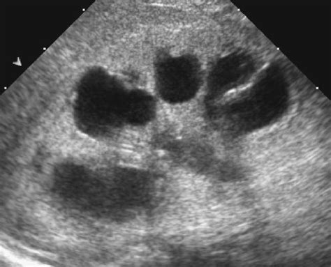 Congenital megacalyces presenting as neonatal hydronephrosis ...