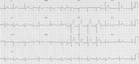 Sinus Arrhythmia • LITFL Medical Blog • ECG Library Basics