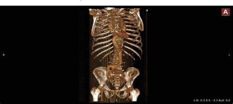 Figure 1 from Hybrid treatment of aortic bifurcation aneurysm | Semantic Scholar