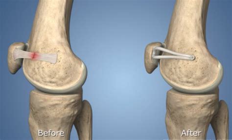 Patellar Dislocation - Unstable Kneecap Treatment