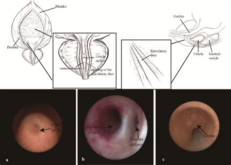 Anatomy of the verumontanum, utricle and ejaculatory duct | Download ...