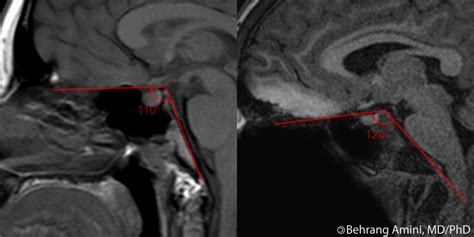 Tuberculum Sellae