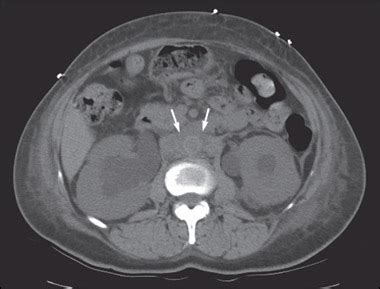 Retroperitoneal Fibrosis | Consultant360