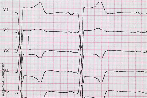 ECG. Myocardial infarction on ECG, subendocardial ischemia in chest leads. Angina. Chest pain ...