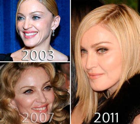 Madonna Plastic Surgery: Facelift, Eyelift, Lip Injections