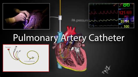 Pulmonary artery catheter (Swan-Ganz Catheter) placement and physiology - YouTube