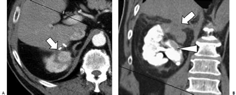 7 Kidney Ablation | Radiology Key