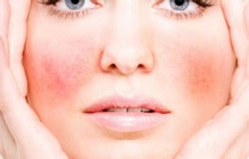 5 Ways to Treat Spider Veins of the Face | Masterpiece Skin Restoration