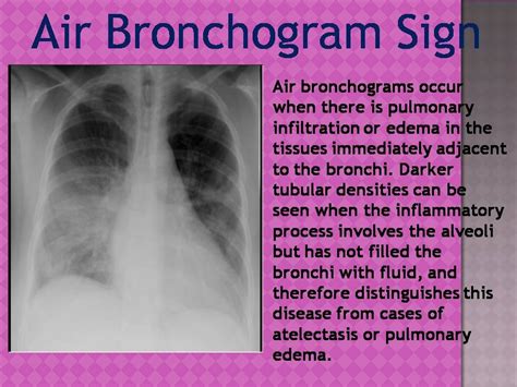 AIR BRONCHOGRAM - Radiology Classroom